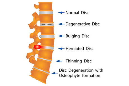 Disc Problems