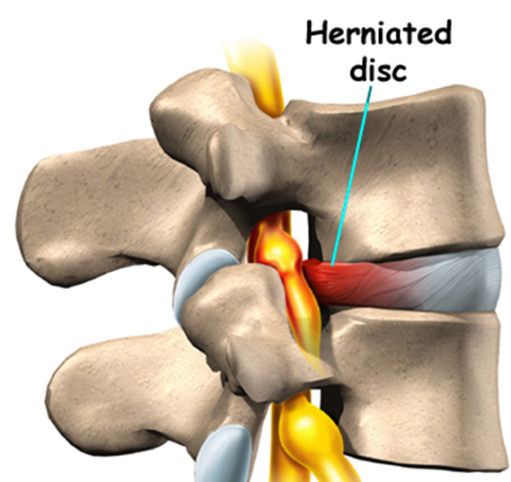 Herniated Disc Pain Relief in Ironbound district of Newark NJ Herniated Disc Pain Relief in Ironbound district of Newark NJ