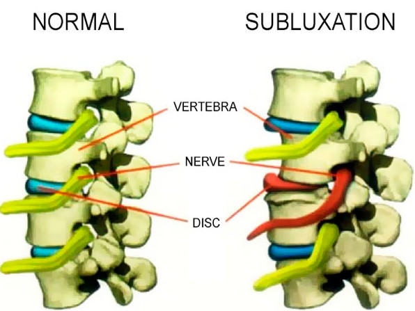 Subluxation Defined in Newark, NJ